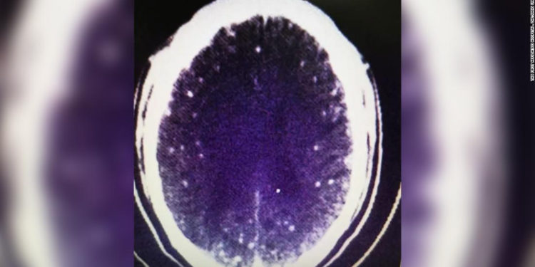 Neurocisticercosis: Un hombre tuvo convulsiones después de comer un caldo. Resulta que tenía tenias en el cerebro