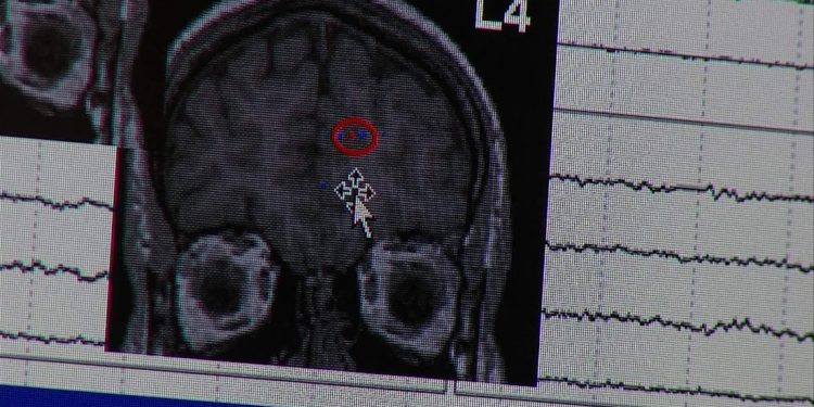 ¿Qué es la epilepsia? Esto es lo que necesitas saber sobre el espectro de trastornos que causan convulsiones